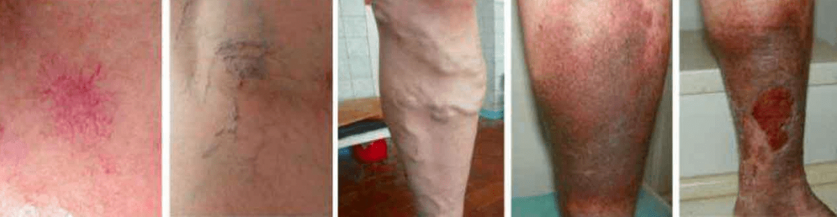 A lábak varikozusának szakaszai