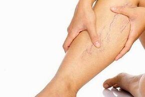 A varikozusok fejlődésének okai a lábakon