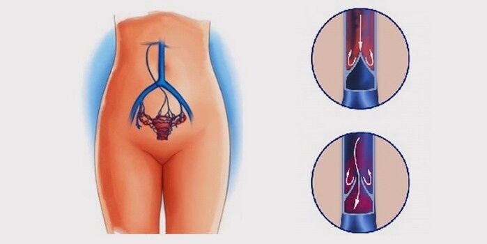 Miért fordulnak elő a medence visszerek