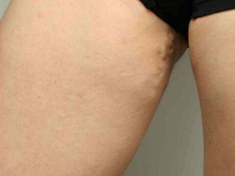 kismedencei visszér terhesség alatt